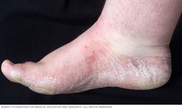 Athlete’s Foot (Tinea Pedis)