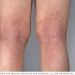 Atopic dermatitis behind the knees Atopic dermatitis can cause a very itchy rash. Atopic dermatitis most often occurs where the skin flexes — inside the elbows, behind the knees and in front of the neck.