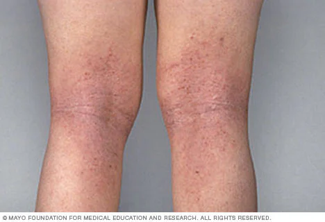 Atopic dermatitis behind the knees Atopic dermatitis can cause a very itchy rash. Atopic dermatitis most often occurs where the skin flexes — inside the elbows, behind the knees and in front of the neck.
