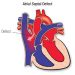 Atrial Septal Defect (ASD)