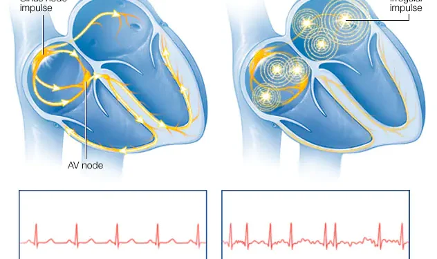 Atrial fibrillation