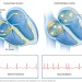 Atrial fibrillation