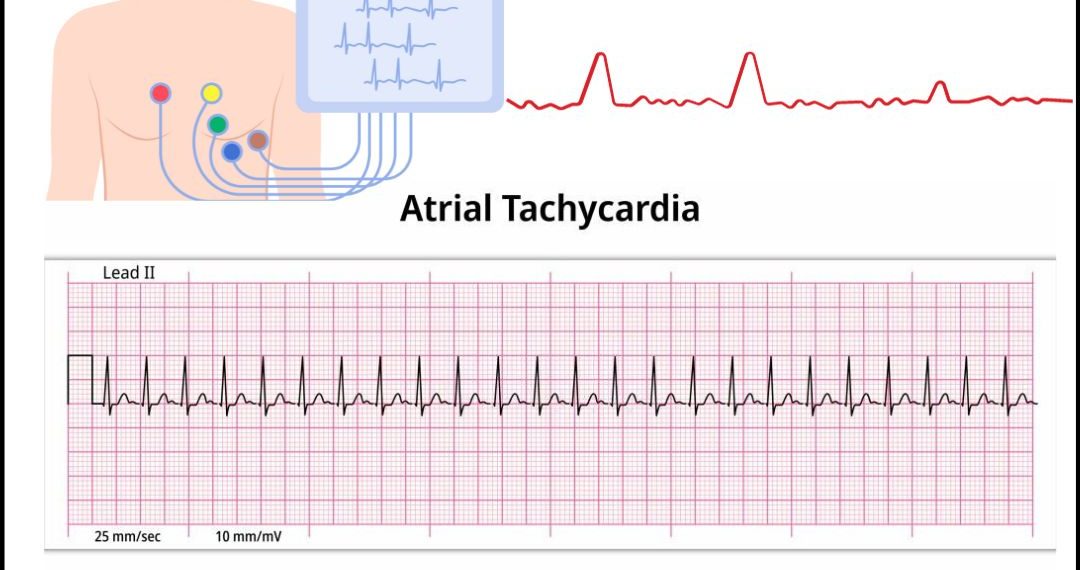 Atrial tachycardia
