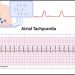 Atrial tachycardia