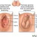 Atypical Genitalia