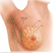 Atypical Hyperplasia of the Breast