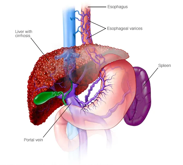 Esophageal varices