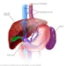 Esophageal varices