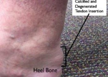 achilles tendinitis