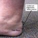 achilles tendinitis