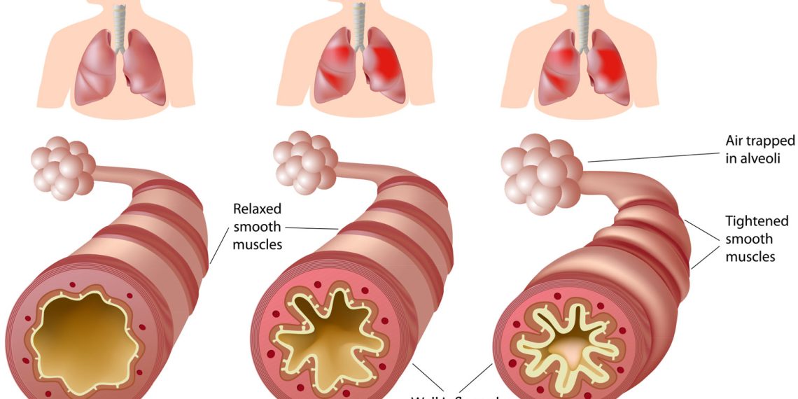 Asthma