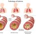 Asthma