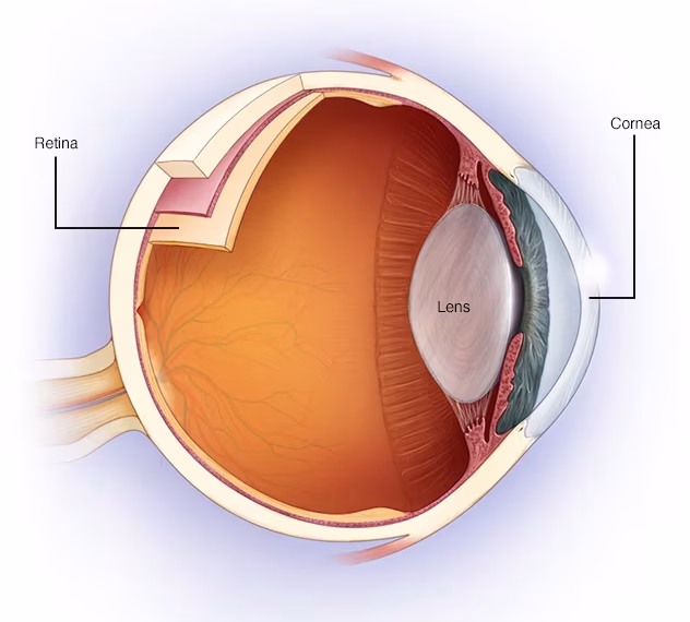 Astigmatism
