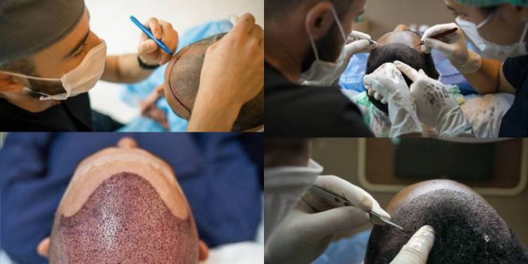 Hair Transplants in Kenya